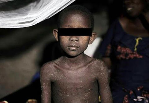 Centrafrique : réapparition de l’épidémie de la rougeole à Rafaï