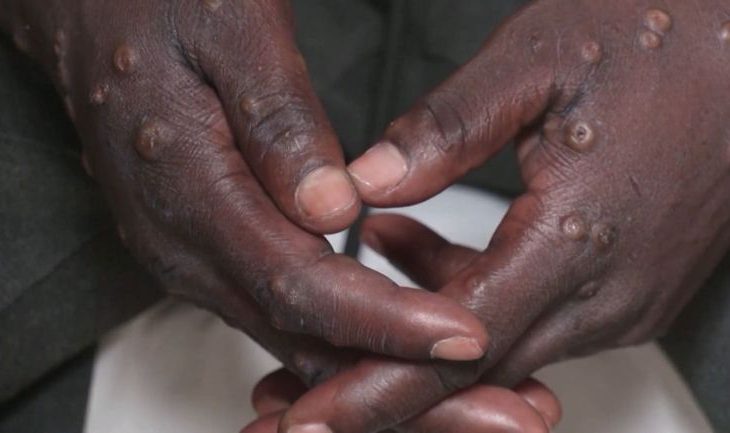 Centrafrique : un premier cas de Mpox recensé à Sibut dans la Kémo