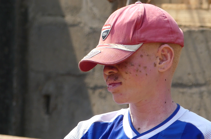 Centrafrique : stigmatisés, les albinos dénoncent l’absence de loi pour leur protection