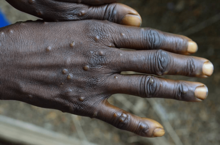 Boutons sur la peau et plaies sur les lèvres, une maladie inconnue sévit à Ouandja