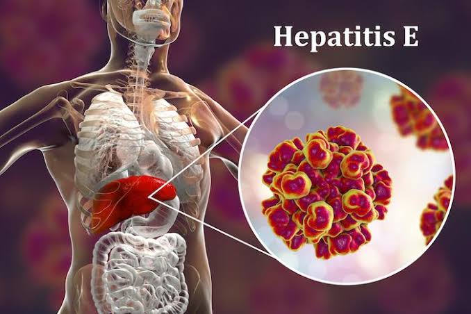 Hépatite E : comprendre une maladie encore méconnue