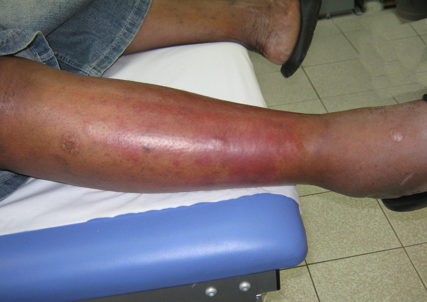 Érysipèle : une infection de la peau à ne pas négliger