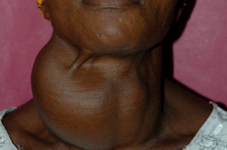 Toutes les tuméfactions sont guérissables par la chirurgie