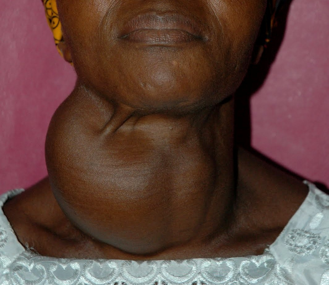 Toutes les tuméfactions sont guérissables par la chirurgie