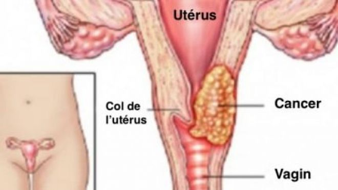 Que savoir du cancer du col de l’utérus ?