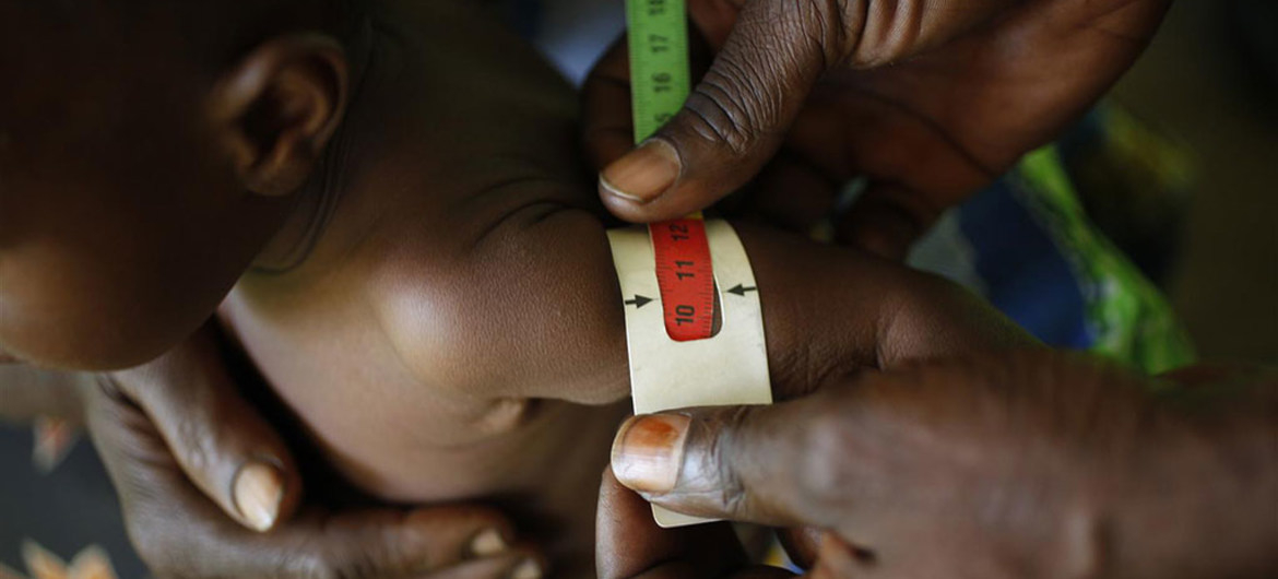 La malnutrition, une maladie qui frappe les enfants en Centrafrique