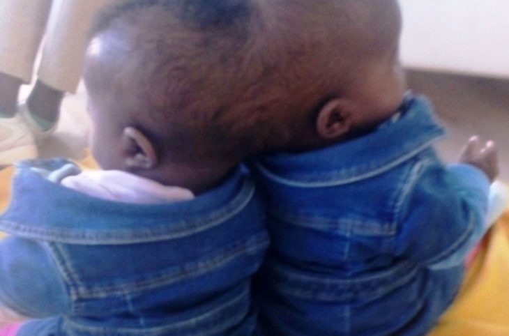 Centrafrique: une intervention chirurgicale avec succès de deux enfants siamois