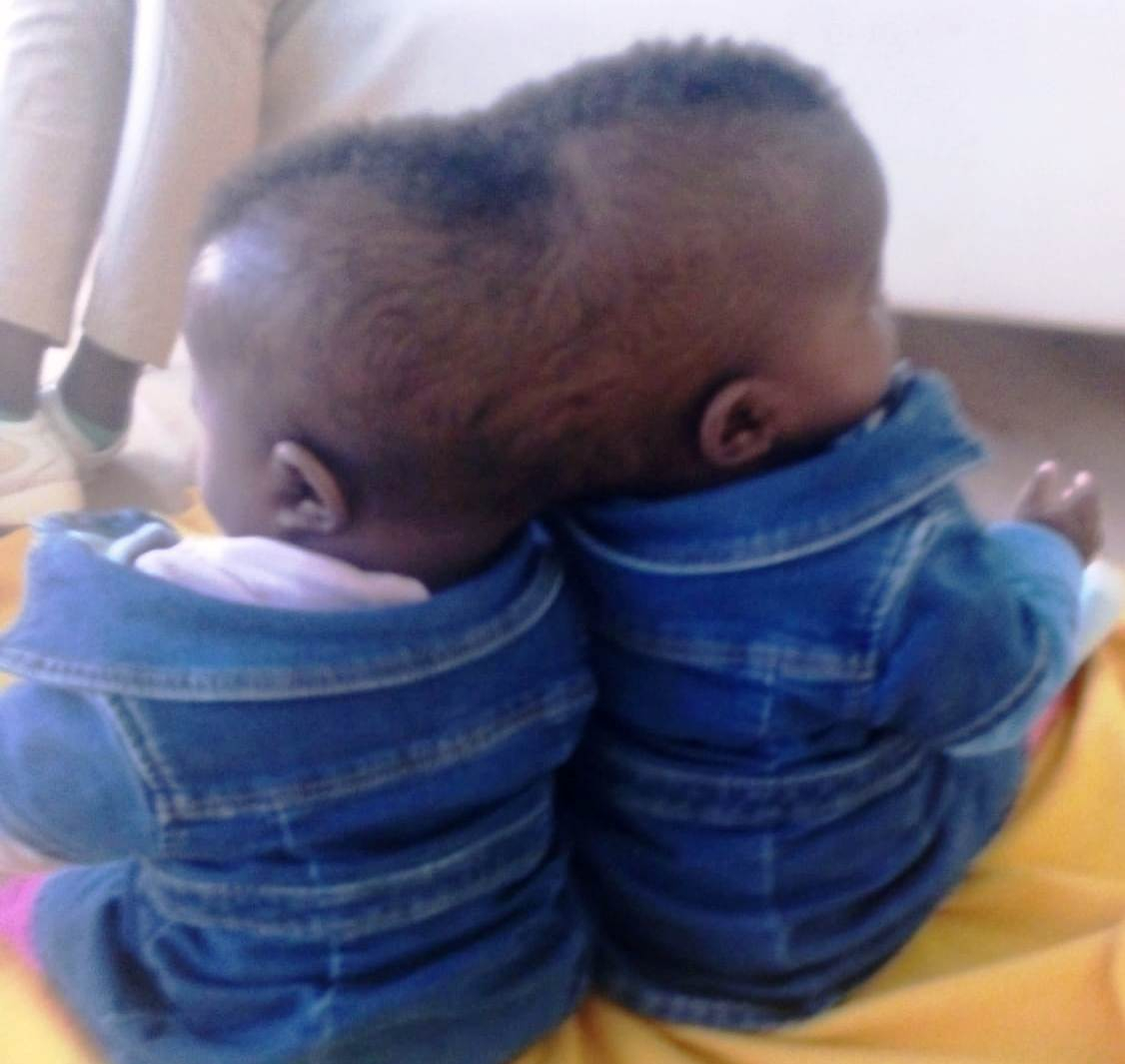 Centrafrique: une intervention chirurgicale avec succès de deux enfants siamois