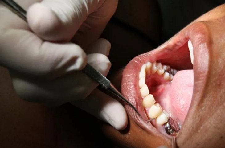 Mag-santé : qu’est ce qui provoque la carie dentaire et comment la prévenir ?