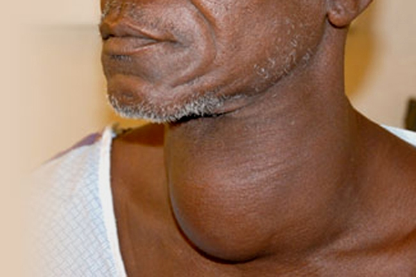 Que peut-on faire pour éviter la maladie de goitre ?