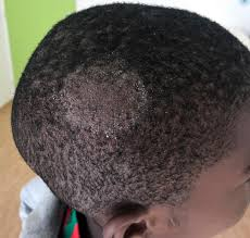 Qu'est ce qui provoque la teigne et comment la prévenir ?