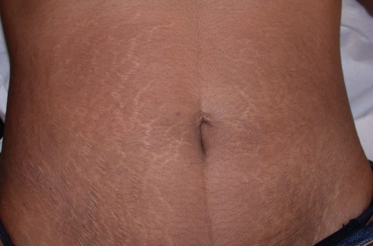 Les vergétures, une déchirure des tissus conjonctifs du derme