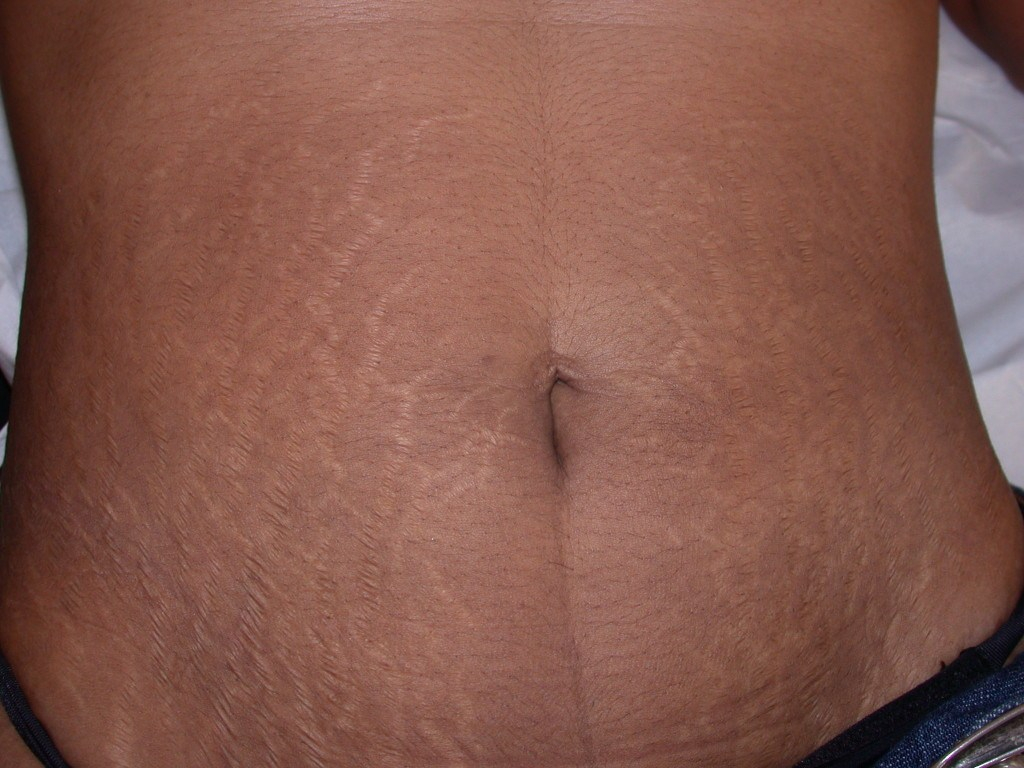 Les vergétures, une déchirure des tissus conjonctifs du derme