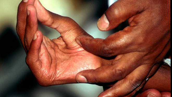 Comment reconnaitre les premiers signes de la lèpre ? Quels sont les modes de traitement ?