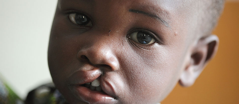 Centrafrique : lancement d’une semaine de sensibilisation et de prise en charge des fentes labio-palatines