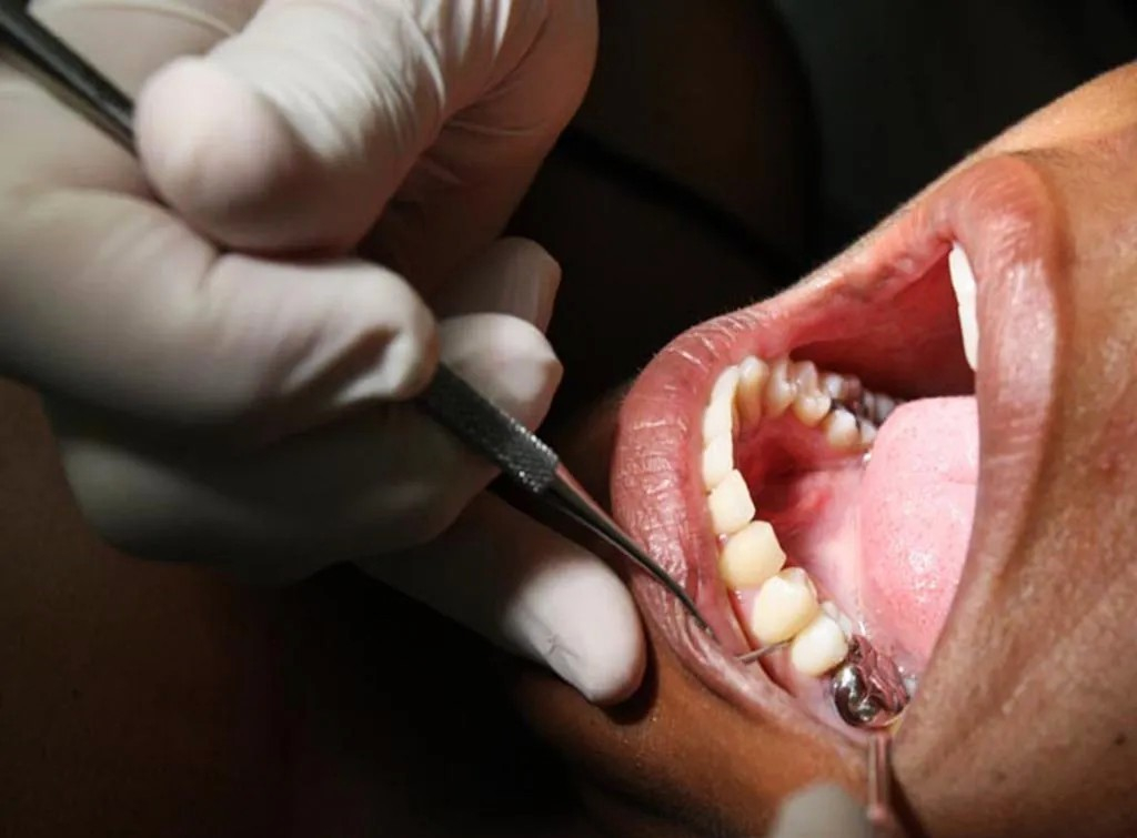 Mag-santé : qu’est ce qui provoque la carie dentaire et comment la prévenir ?
