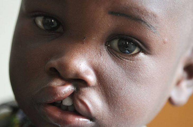 Mag-santé : que savoir de la prise en charge de la fente labio-palatine ?