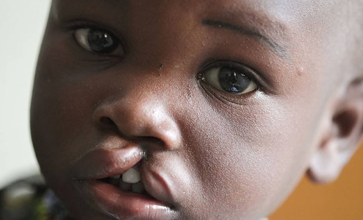 Mag-santé : que savoir de la prise en charge de la fente labio-palatine ?