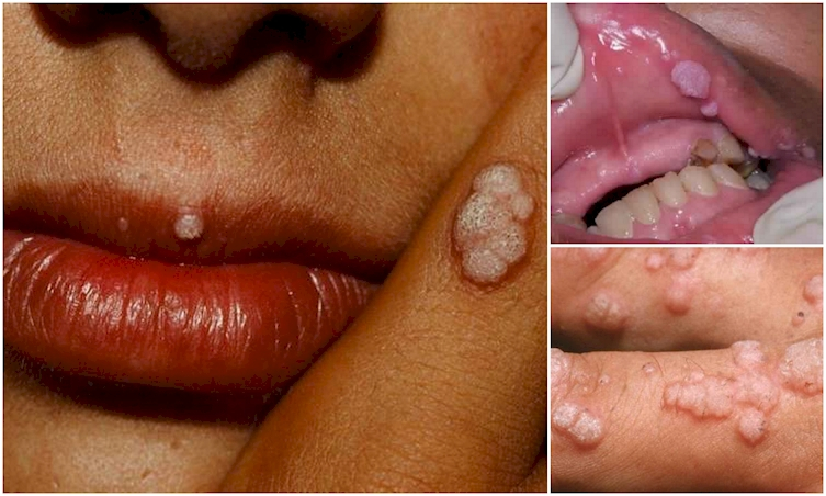 Comment se prévenir des infections sexuellement transmissibles (IST)