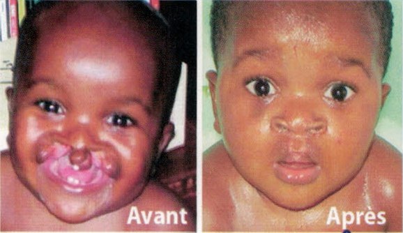 RCA : Une campagne de chirurgie craniofaciale lancée à Bangui