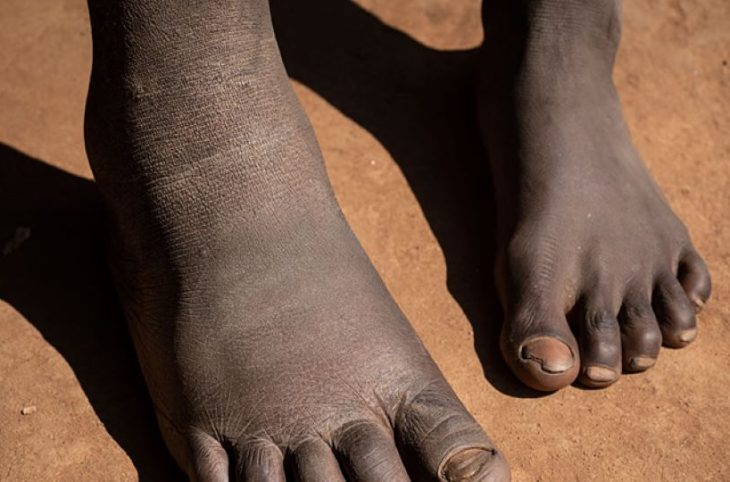 L’éléphantiasis : est-ce une maladie héréditaire ?