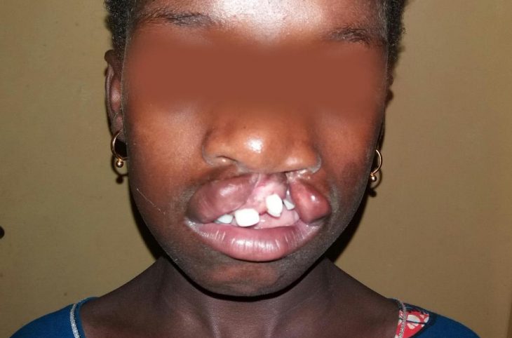 RCA : Plus de 100 personnes atteintes du bec de lièvre traitées à Bangui