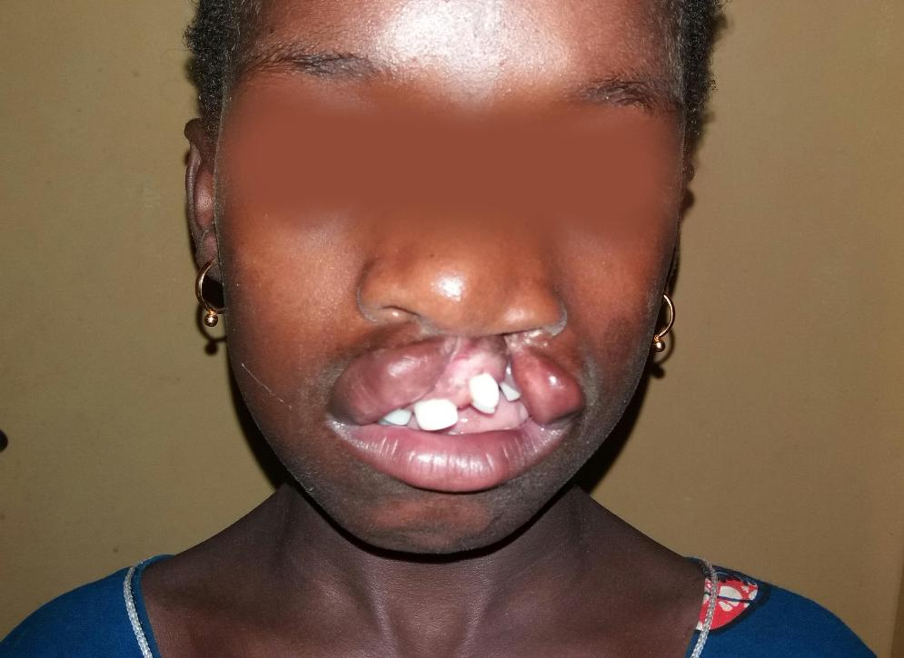 RCA : Plus de 100 personnes atteintes du bec de lièvre traitées à Bangui